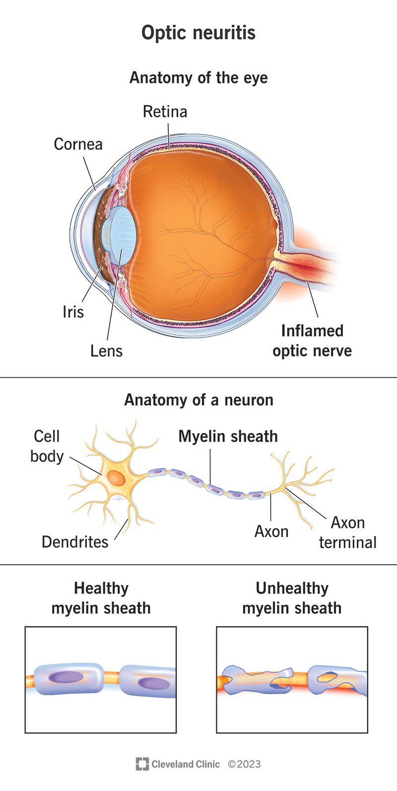 Optic neuritis, anatomy of the eye, anatomy of a neuron, healthy and unhealthy myelin sheath