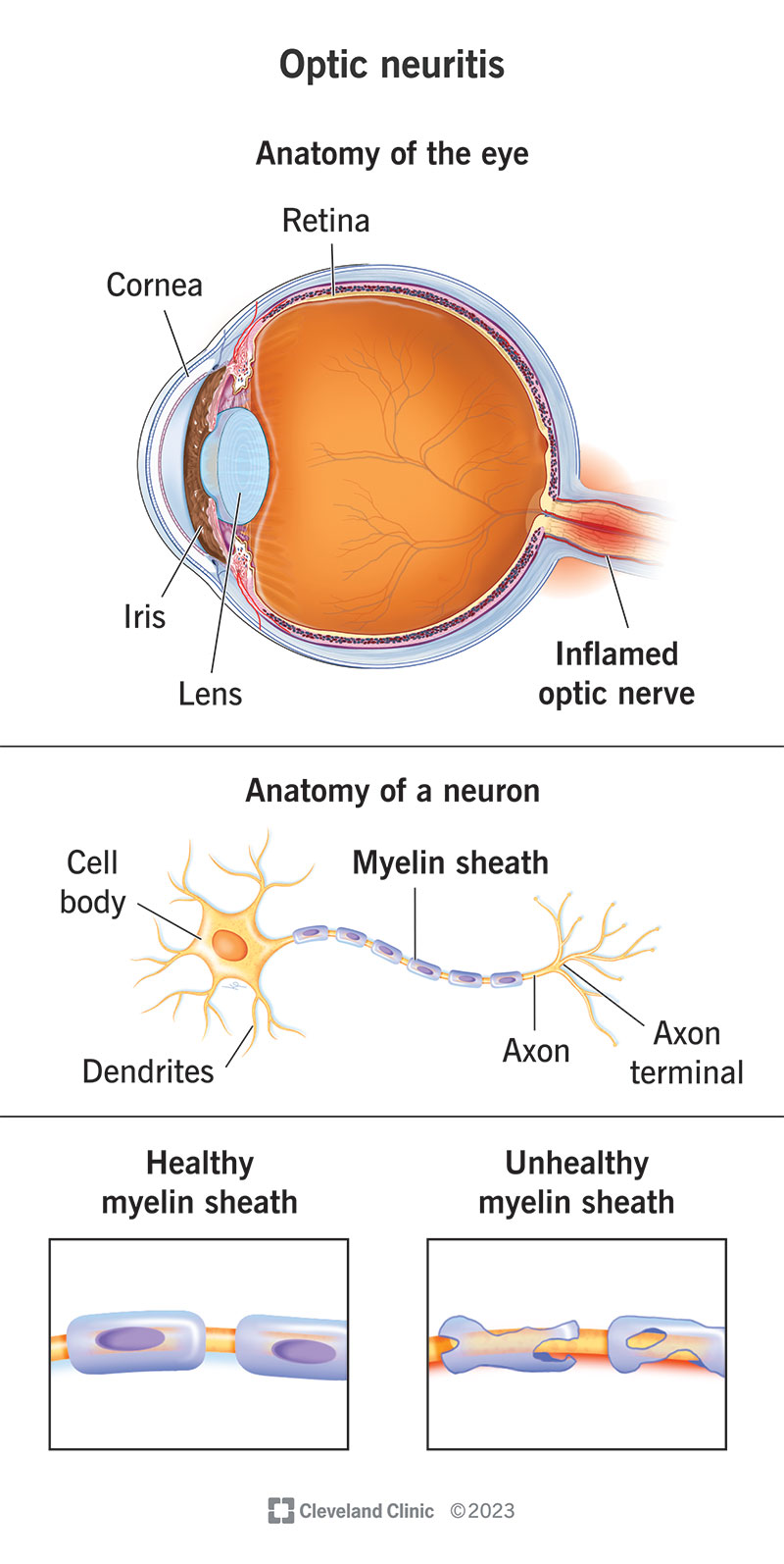 Inflammatory Arthritis and Eye Health: Prevention, Symptoms, Treatment