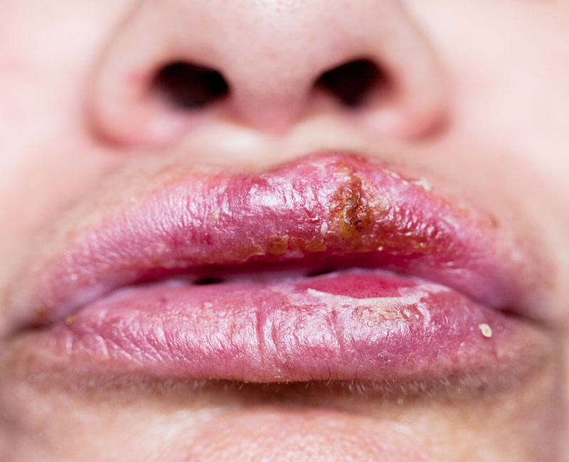 Cold sores (blisters on your lips) are the most common sign of an oral herpes infection.