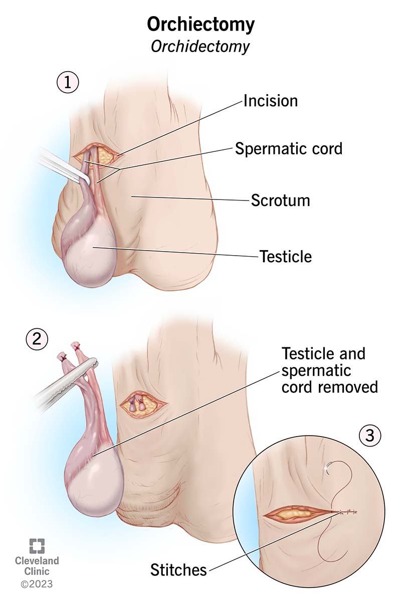 Testicles showing where incisions are made during ochiectomy.