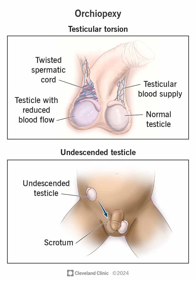 Twisted spermatic cord in testicular torsion and an undescended testicle in the abdomen