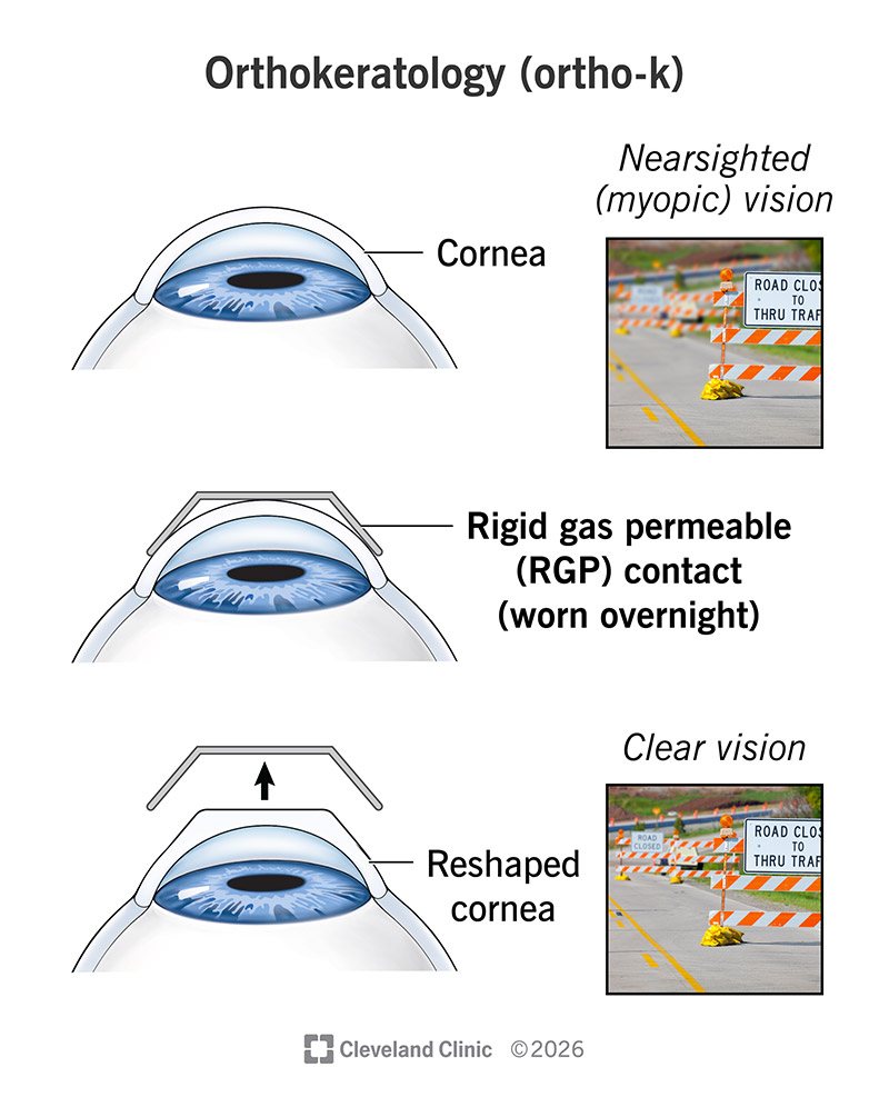 Orthokeratology contact reshaping a cornea to correct nearsightedness