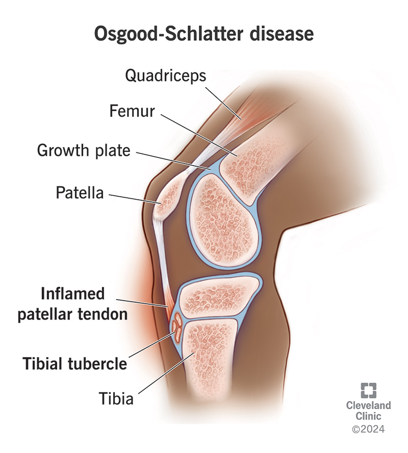 Osgood-Schlatter disease is painful inflammation in a child’s patellar tendon where it connects to their tibia (shin bone).