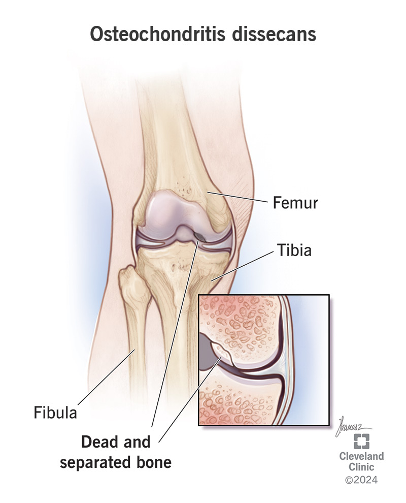 Osteochondritis dissecans softens and weakens a section of bone in a joint.