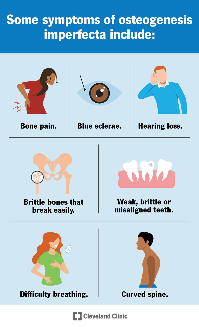 Osteogenesis imperfecta symptoms can include brittle bones, blue sclerae, dental issues, breathing issues and more