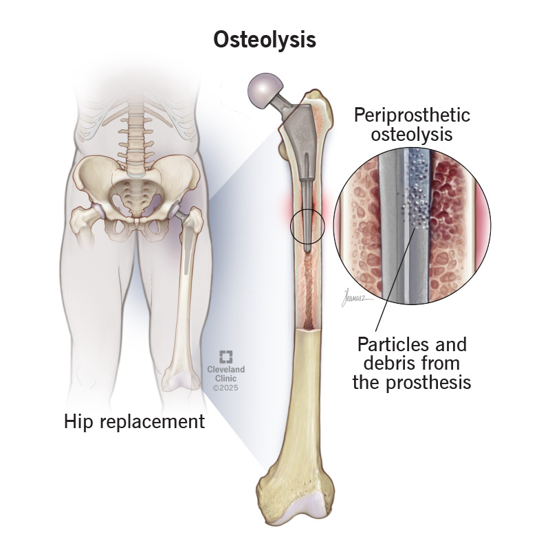 Periprosthetic osteolysis, with particles and debris from a hip prosthesis causing bone loss