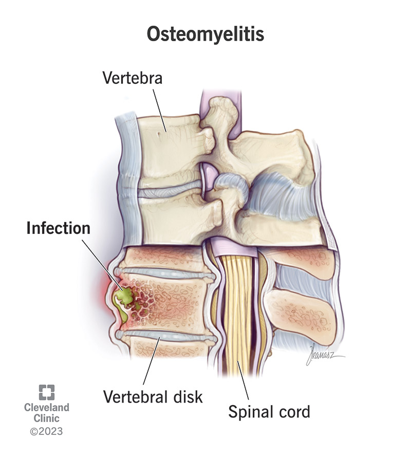 Osteomyelitis is an infection that spreads to your bones.