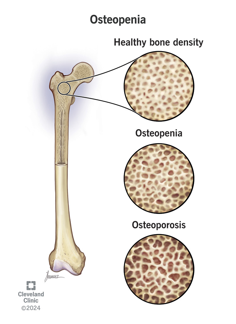 Osteopenia is having reduced bone density, but not severely enough to mean have osteoporosis.