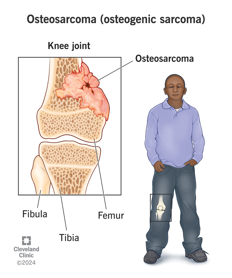 Osteosarcoma is a type of bone cancer that most commonly affects kids and teens.