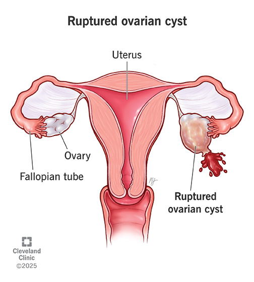 Anatomy of uterus and ovaries, with an ovarian cyst rupturing with blood spilling out
