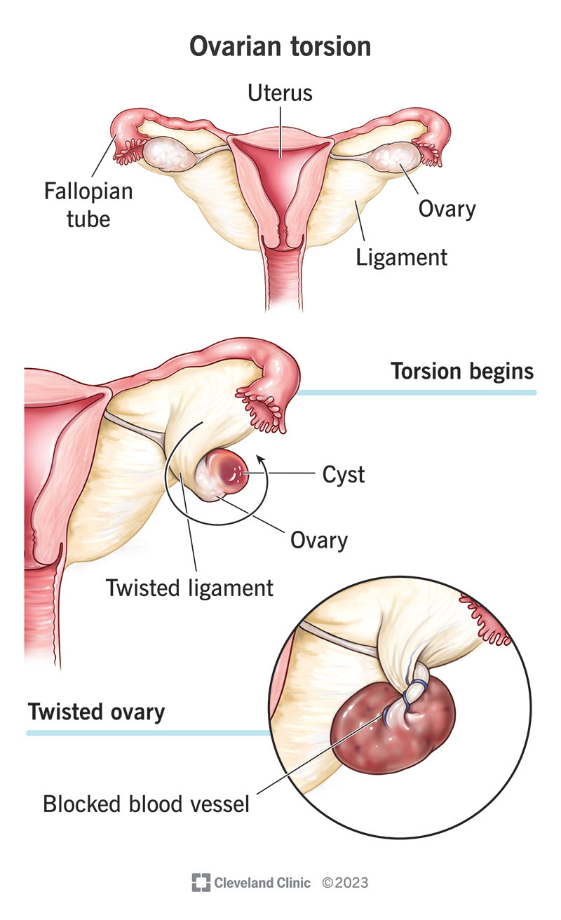 The progression of ovarian torsion from twisting to a complete blockage of blood flow