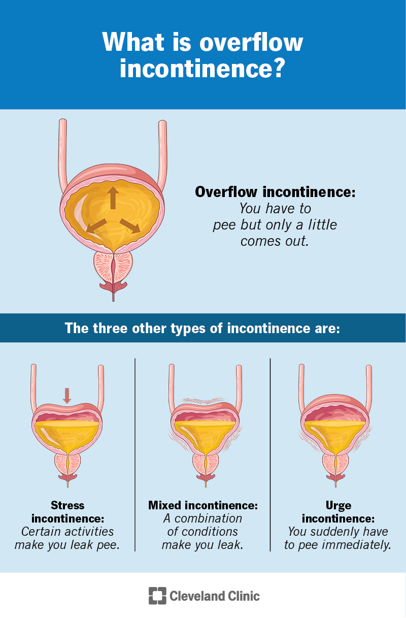 Overflow incontinence is a type of urinary incontinence. Your bladder gets too full and causes problems, including leaks