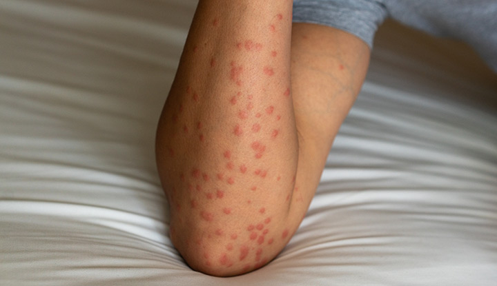 Papular urticaria, with dozens of small, red bumps on a light-skinned forearm