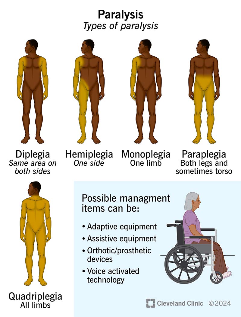 Types of paralysis, including diplegia and hemiplagia, and possible management items them, including adaptive equipment