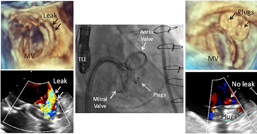 Paravalvular รั่ว