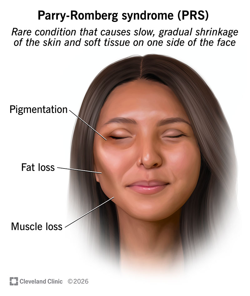 Parry-Romberg syndrome symptoms, with facial pigmentation, fat loss and muscle loss