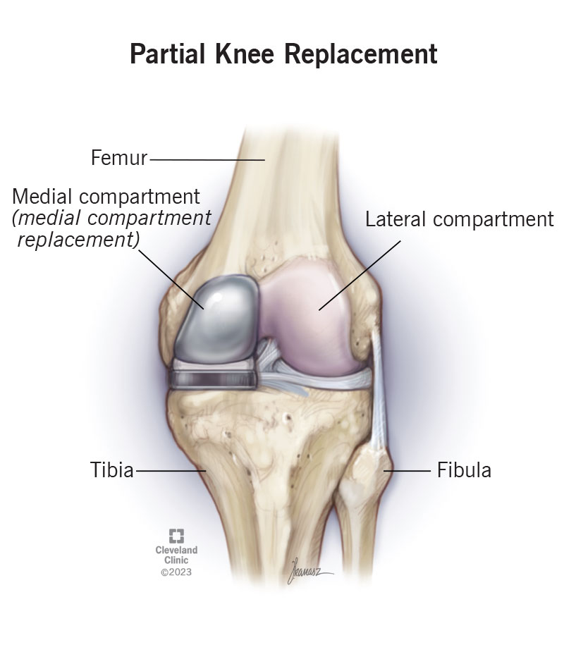 During a partial knee replacement, a surgeon will replace damaged sections of your knee with prosthetic pieces.