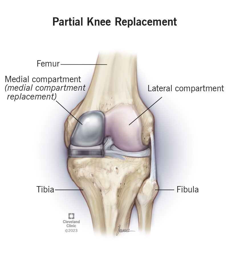 Partial Knee Replacement: What It Is & Recovery Time