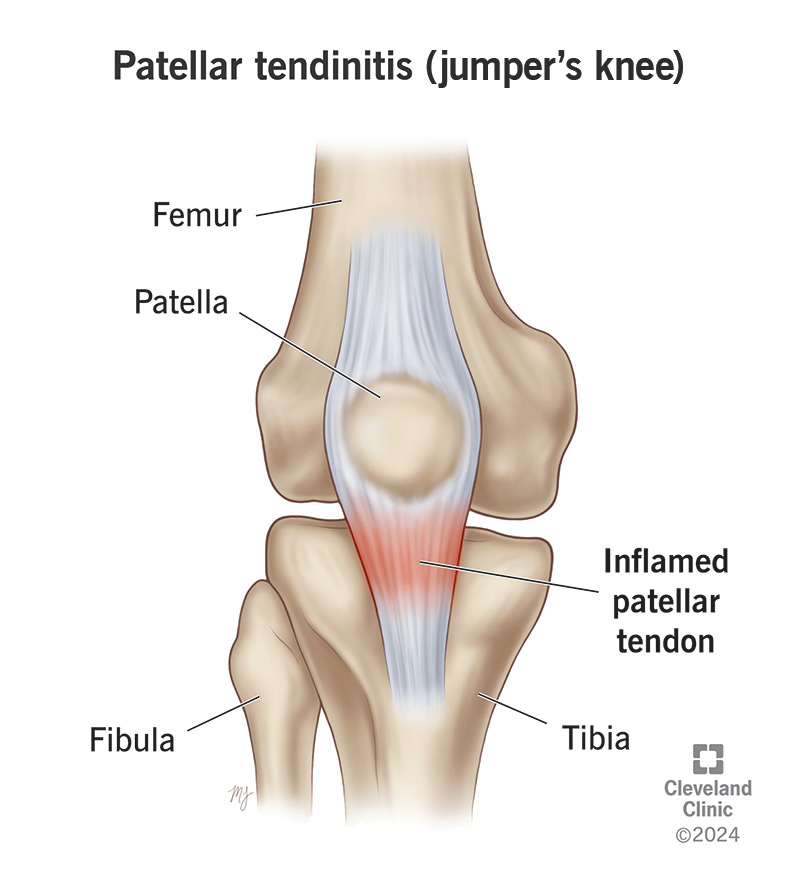 Patellar tendinitis is painful inflammation in the tendon that connects your kneecap to the top of your shin bone.