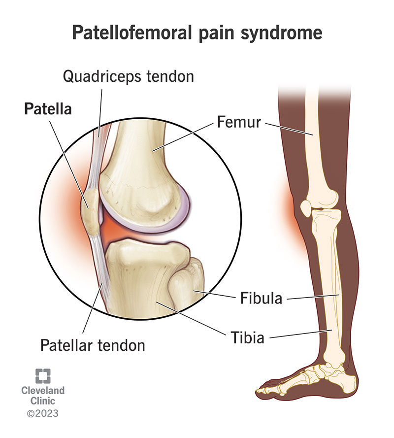 Patellofemoral pain syndrome causes knee pain under or around your kneecap (patella).