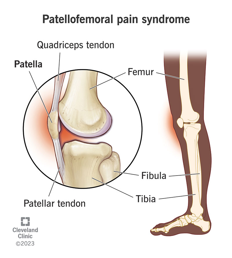 Pain in front on sale of knee cap