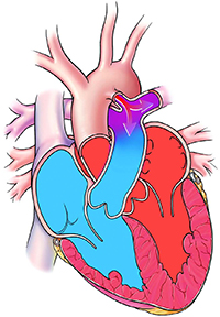 Patent Ductus Arteriosus Pda What Is It Symptoms Treatments