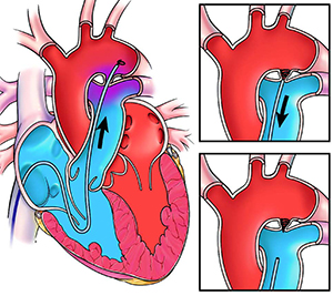 Patent Ductus Arteriosus Pda What Is It Symptoms Treatments