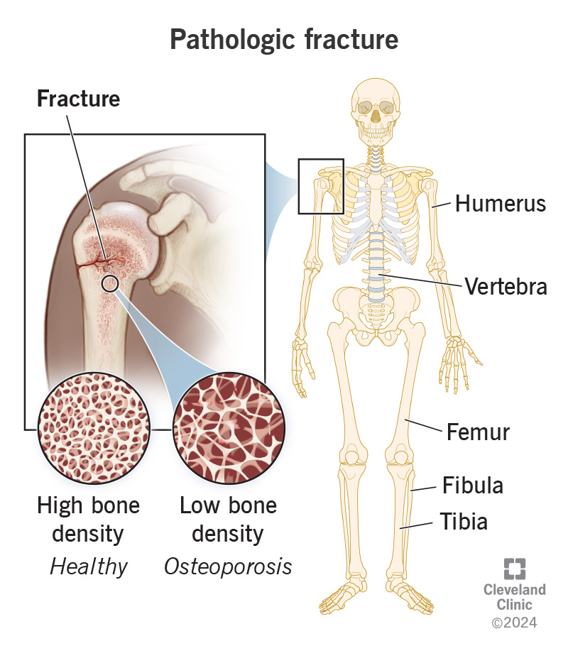 Osteoporosis is one of the most common pathologic fracture causes