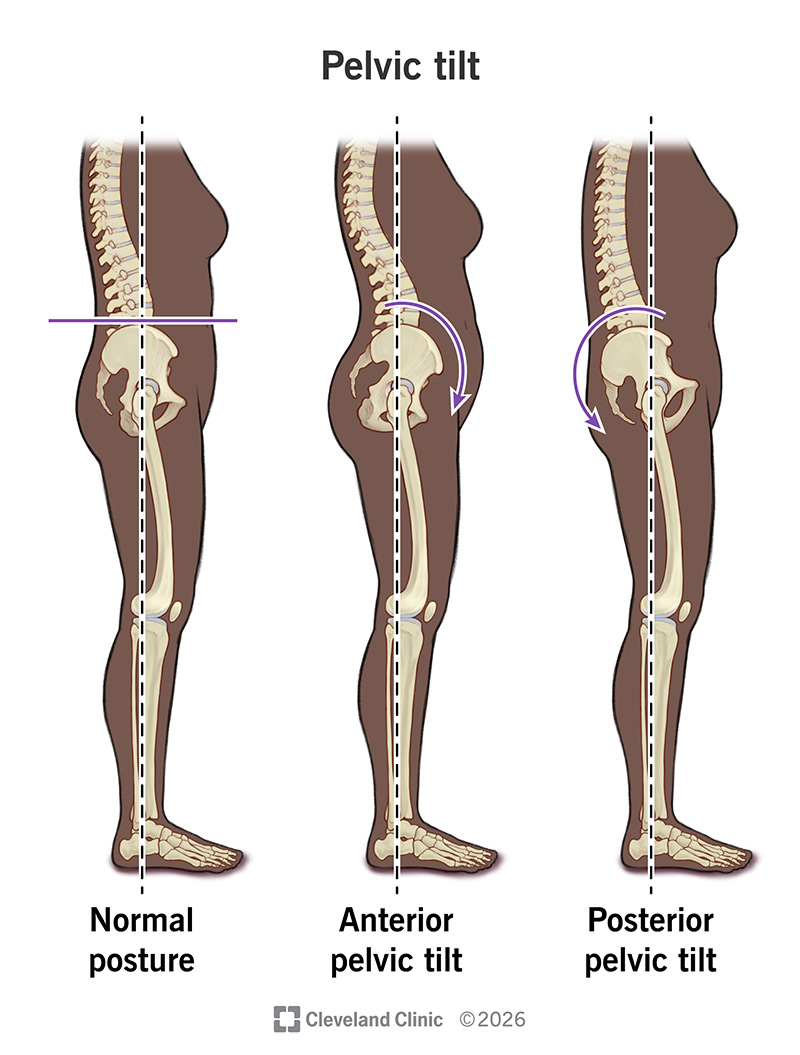 Normal posture compared to anterior pelvic tilt and posterior pelvic tilt