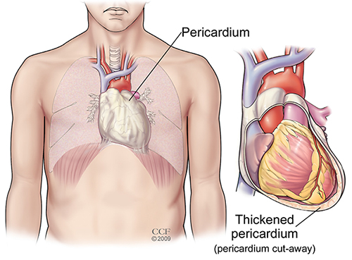 Pericarditis | Cleveland Clinic