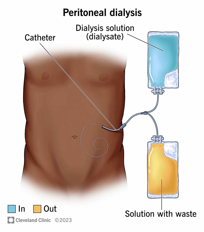 During peritoneal dialysis, you add dialysate into your abdominal lining and later drain the solution