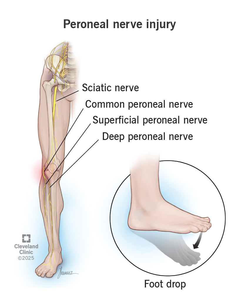 Anatomy of leg, with peroneal nerve injury, affecting lower leg and foot