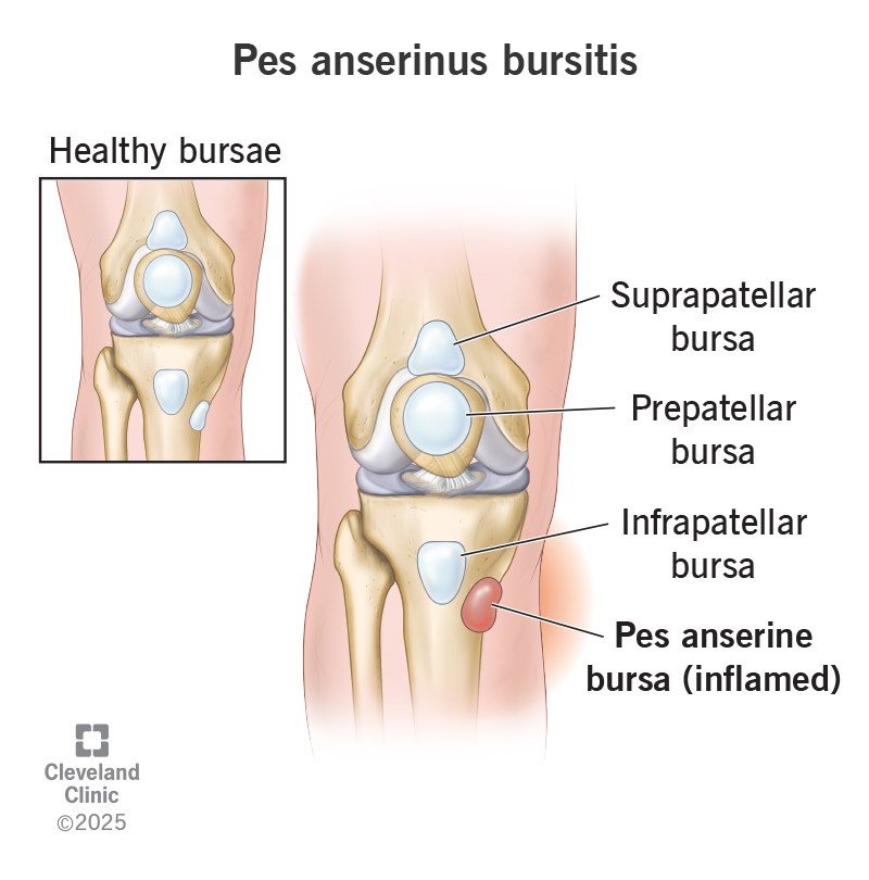 Healthy bursae compared to a pes anserine bursa