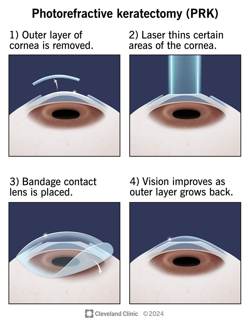 Photorefractive keratectomy starts with removing the outer corneal layers and reshaping the layers beneath with a laser.