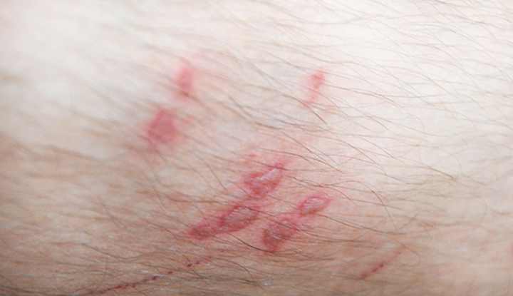 Red streaks and blisters on a person’s skin caused by phytophotodermatitis