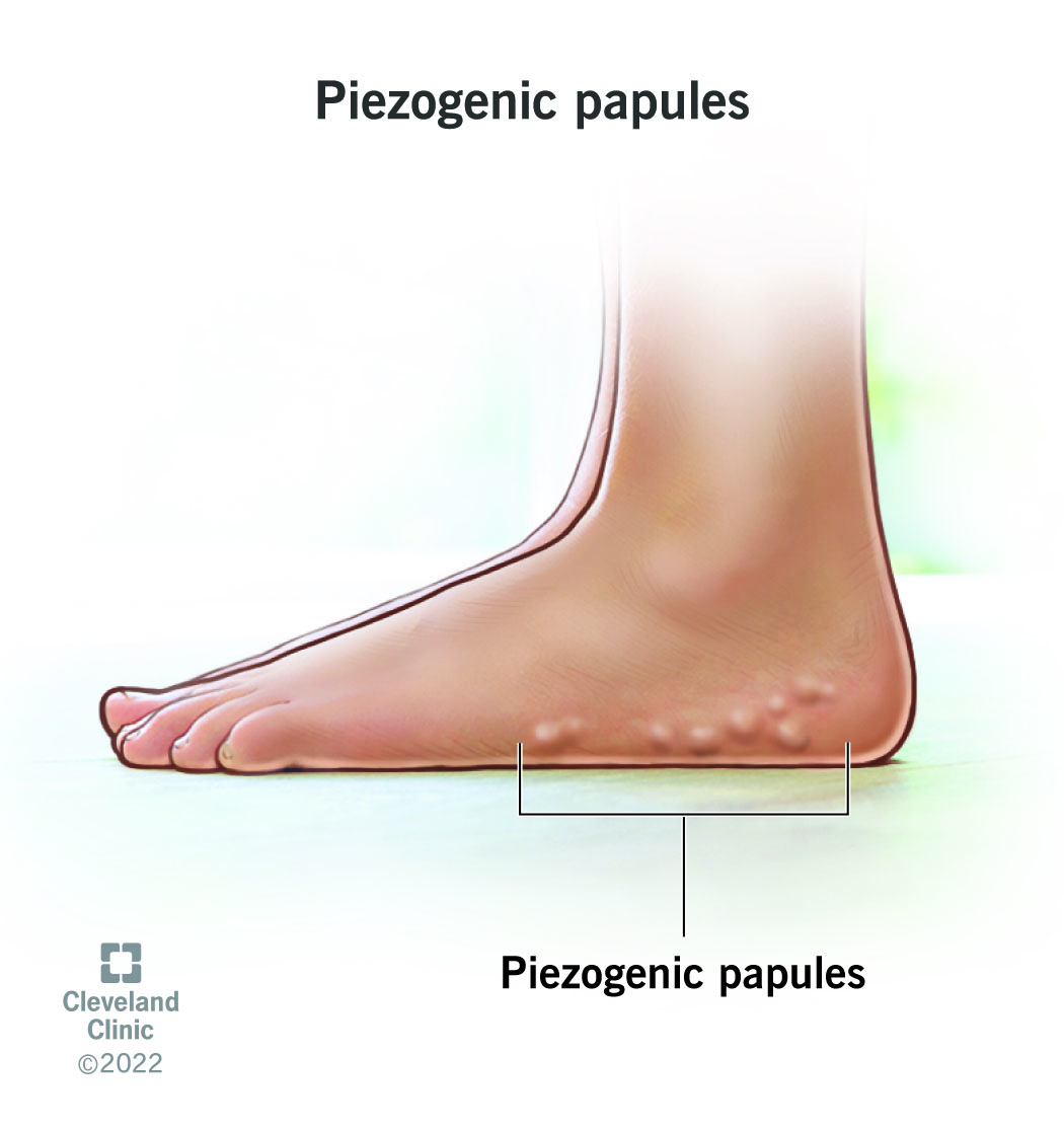 Foot with piezogenic papules