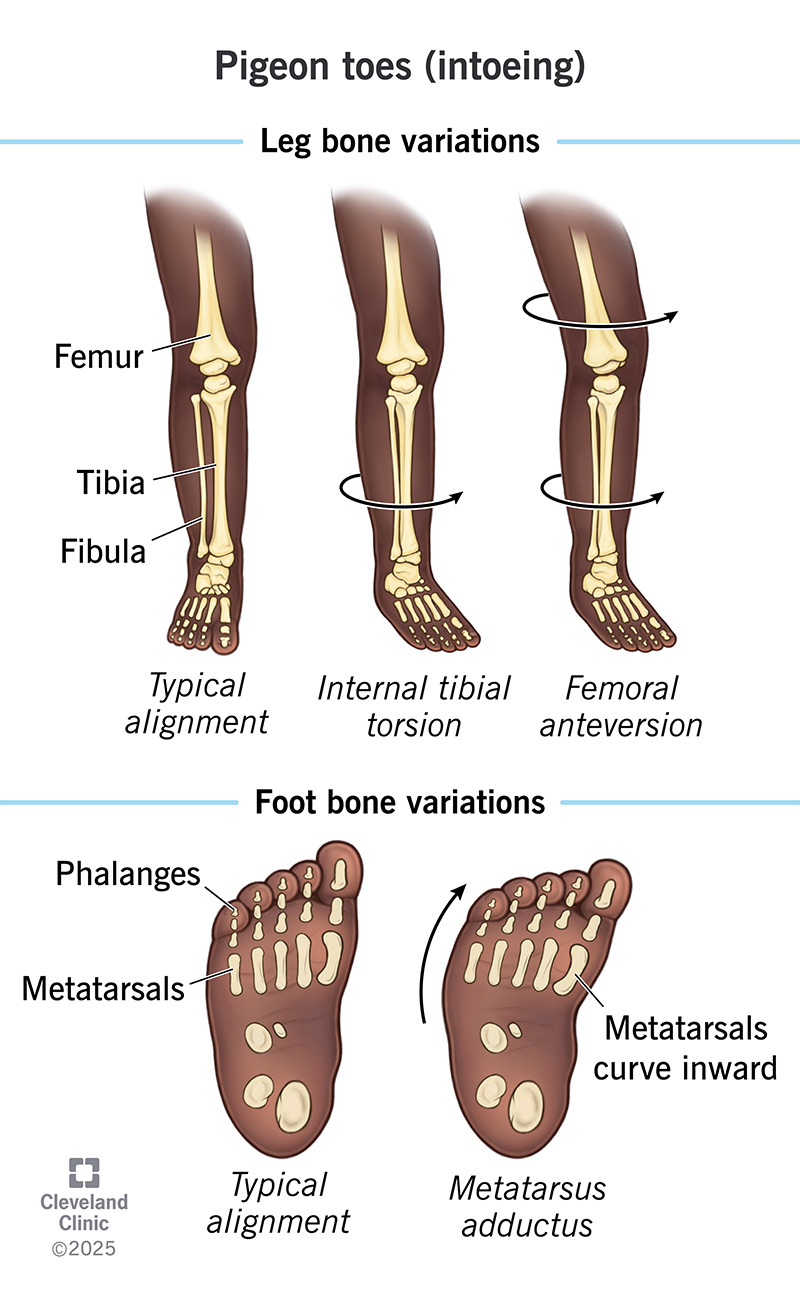Natural variations in your child’s leg or foot bones cause intoeing