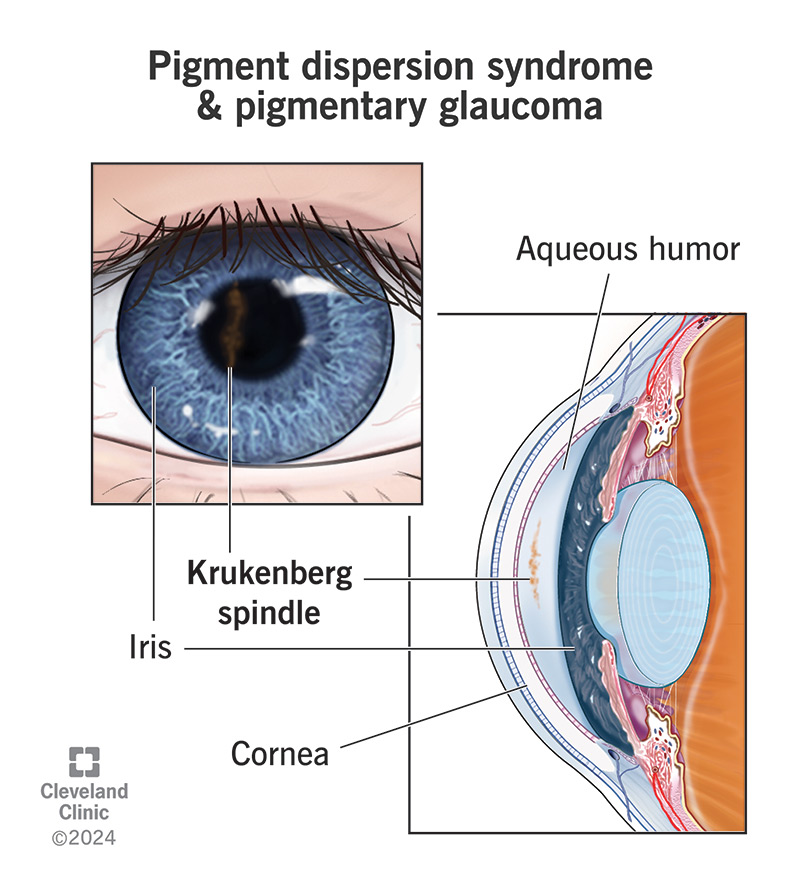 A Krukenberg spindle can form at the back of your cornea when you have pigment dispersion syndrome or pigmentary glaucoma.