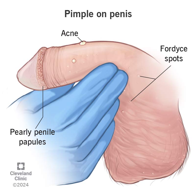 Pimples on your penis can be something simple like acne, or something normal like Fordyce spots or pearly penile papules