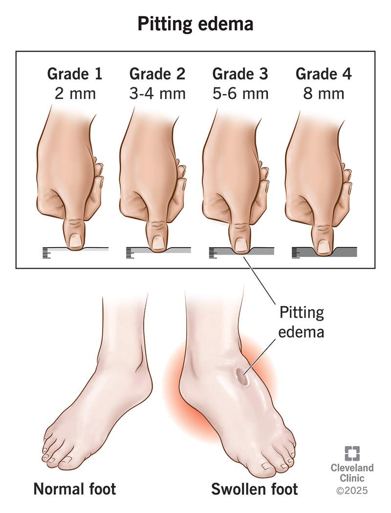 https://my.clevelandclinic.org/-/scassets/images/org/health/articles/pitting-edema.jpg
