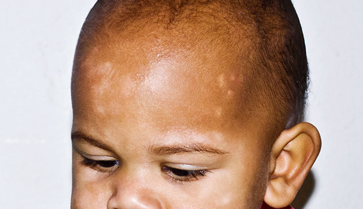 A child with pityriasis alba patches on their head