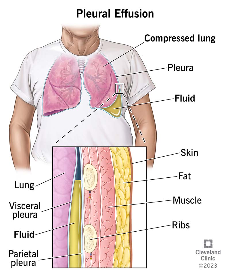 Pleural Effusion Symptoms Causes Treatment