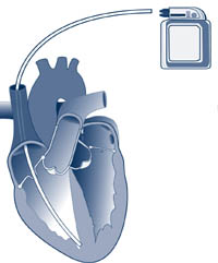 Permanent Pacemaker