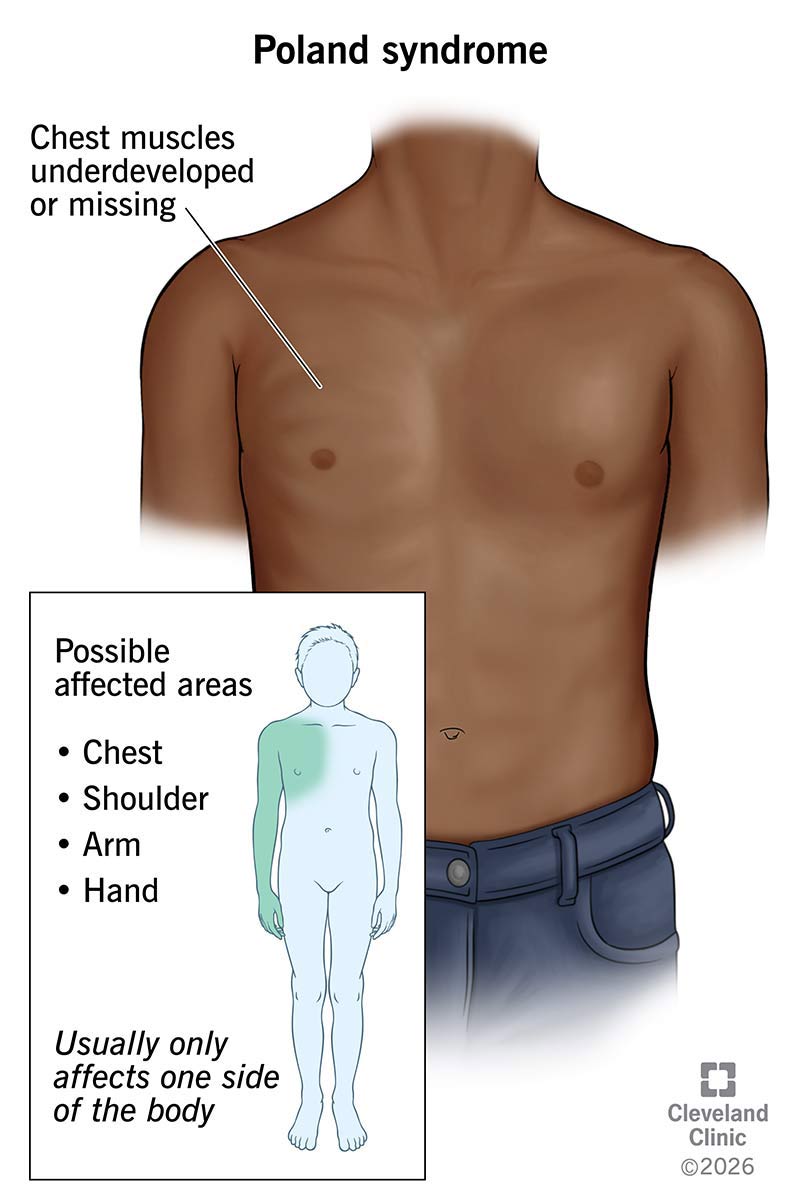 Male with underdeveloped or missing chest muscles due to Poland syndrome; can also affect shoulder, arm and hand of same side