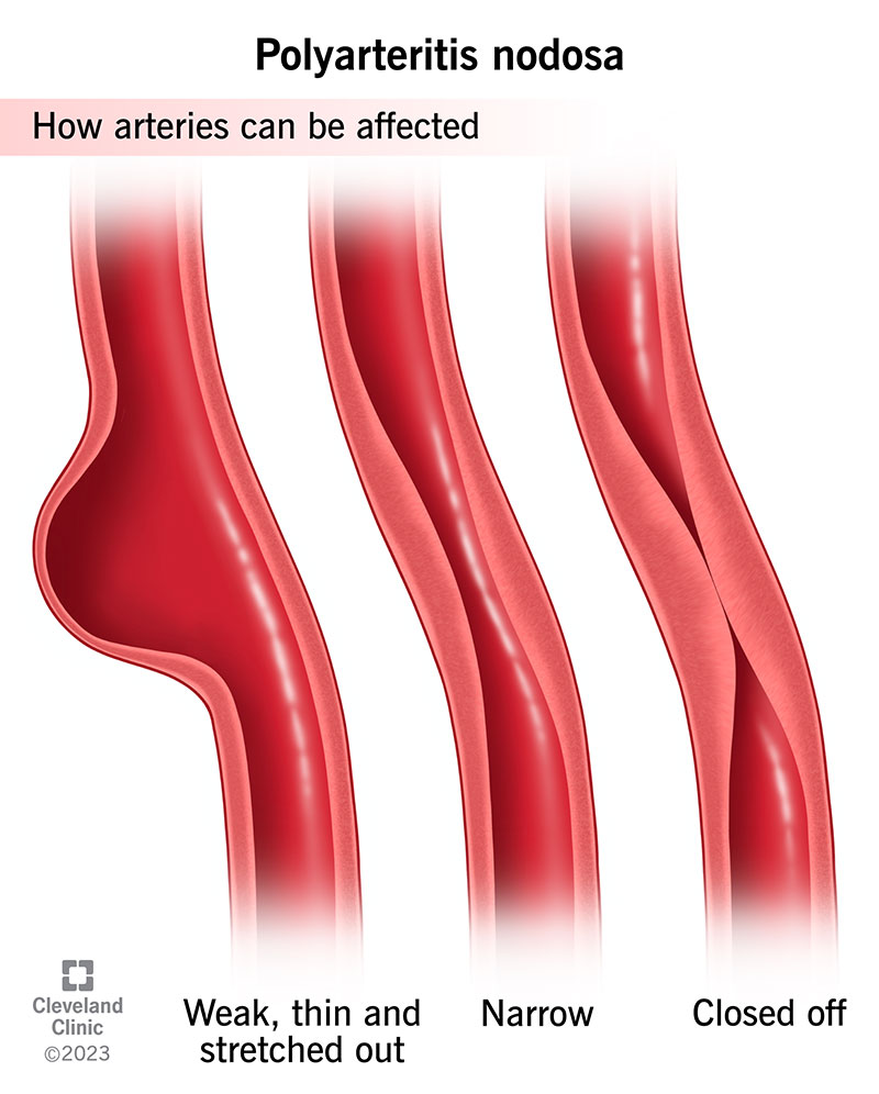 Polyarteritis nodosa inflames your arteries, making them narrow and closed off
