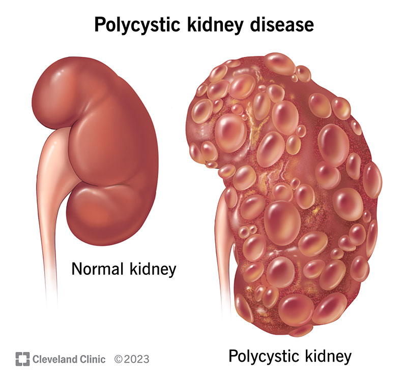 A normal kidney compared to a kidney enlarged with cysts