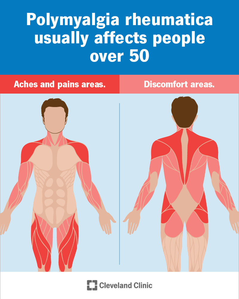Infographic of polymyalgia rheumatica