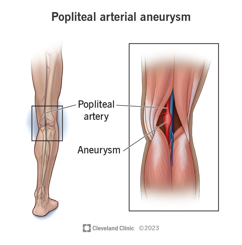 A popliteal aneurysm is a bulging of the artery behind your knee.