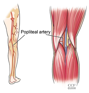 Sindrom Perangkap Arteri Popliteal (PAES)