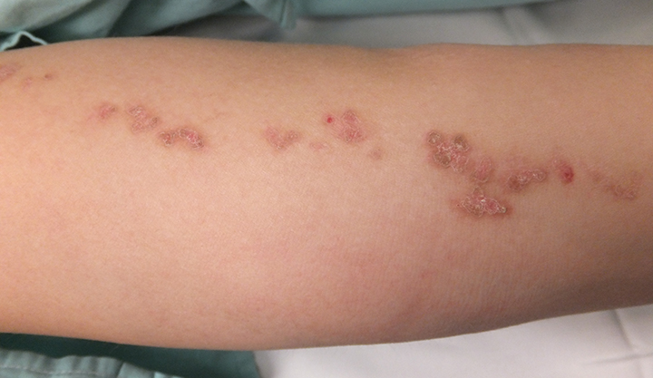 A line of brown and red porokeratosis lesions on an arm